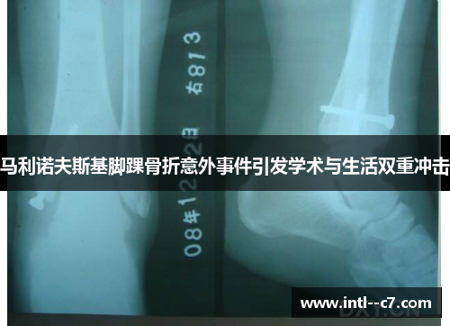 马利诺夫斯基脚踝骨折意外事件引发学术与生活双重冲击 马利诺夫斯基脚踝骨折意外事件引发学术与生活双重冲击